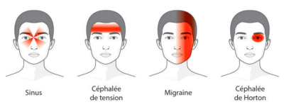 Migraine et ostéopathie, quels effets ? 