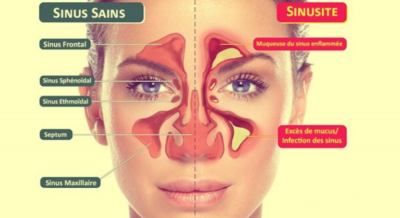 Sinusite chronique et ostéopathie 