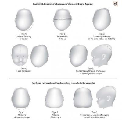  LA PLAGIOCEPHALIE POSTIONNELLE - revue de littérature